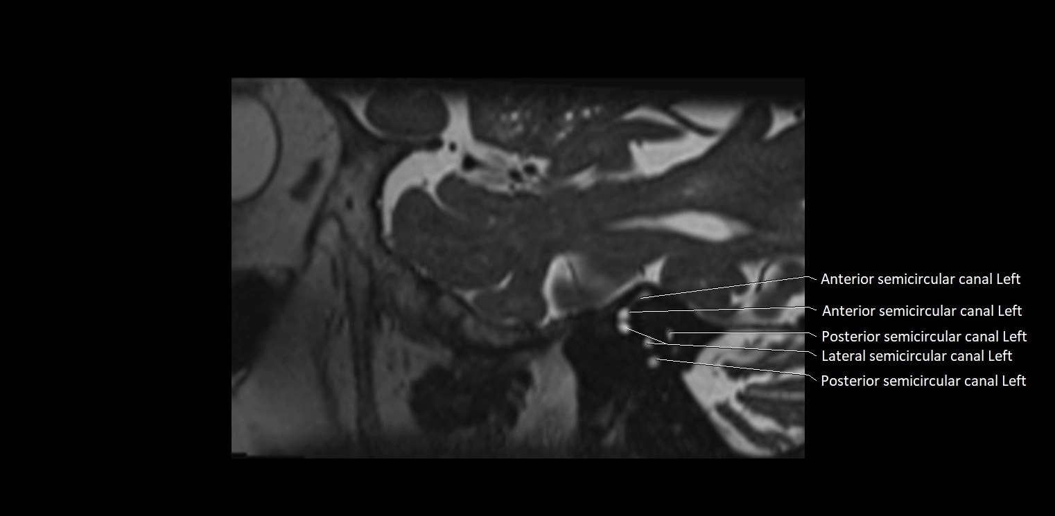 Cranial nerve sagittal anatomy MRI 3T image 4.webp